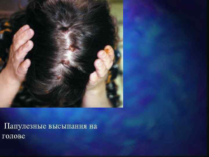  Папулезные высыпания на голове 