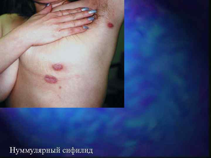 Нуммулярный сифилид 