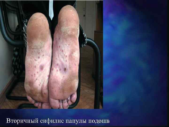 Вторичный сифилис папулы подошв 