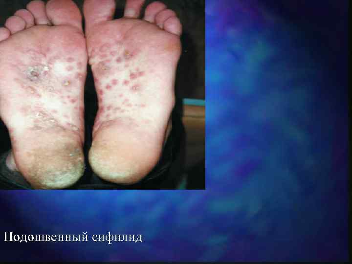 Подошвенный сифилид 