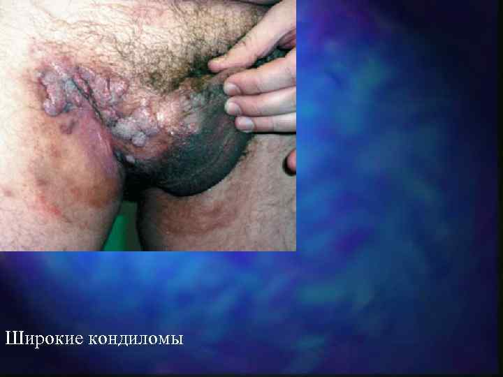 Широкие кондиломы 