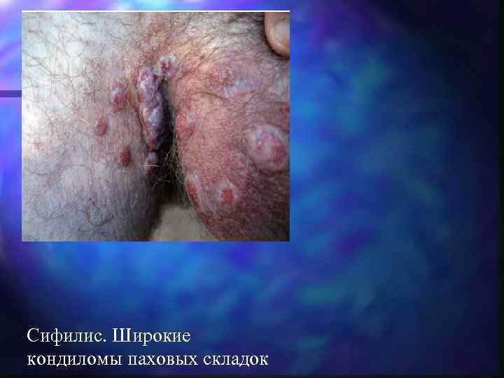 Сифилис. Широкие кондиломы паховых складок 