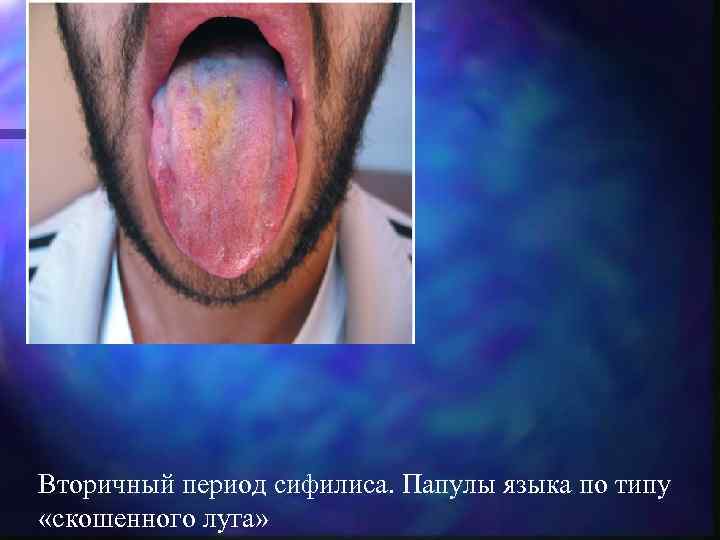 Вторичный период сифилиса. Папулы языка по типу «скошенного луга» 