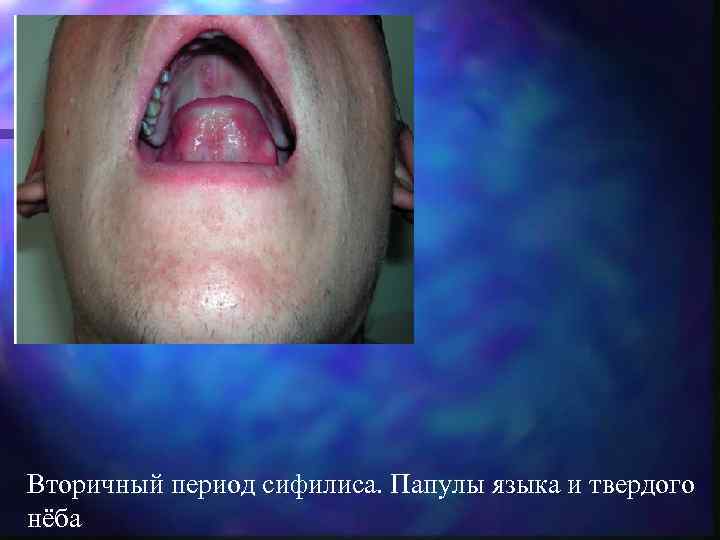 Вторичный период сифилиса. Папулы языка и твердого нёба 