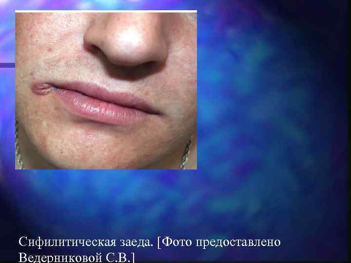 Сифилитическая заеда. [Фото предоставлено Ведерниковой С. В. ] 