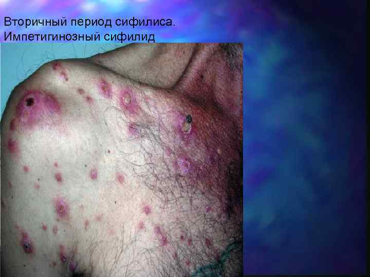 Вторичный период сифилиса. Импетигинозный сифилид 