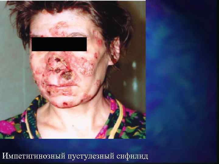 Импетигинозный пустулезный сифилид 