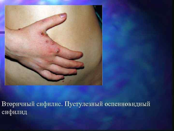 Вторичный сифилис. Пустулезный оспенновидный сифилид 