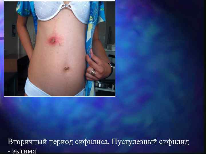 Вторичный период сифилиса. Пустулезный сифилид - эктима 