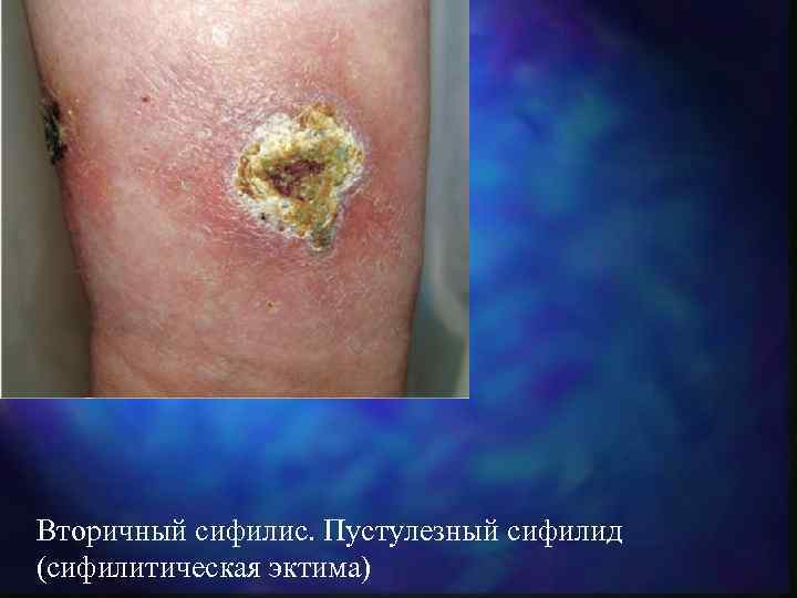 Вторичный сифилис. Пустулезный сифилид (сифилитическая эктима) 