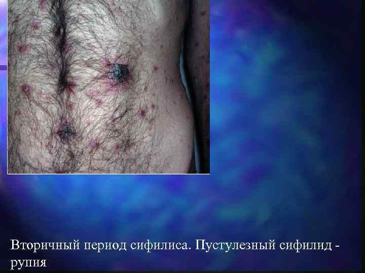 Вторичный период сифилиса. Пустулезный сифилид - рупия 