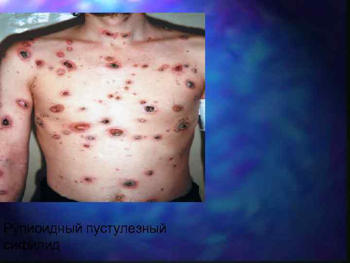 Рупиоидный пустулезный сифилид 