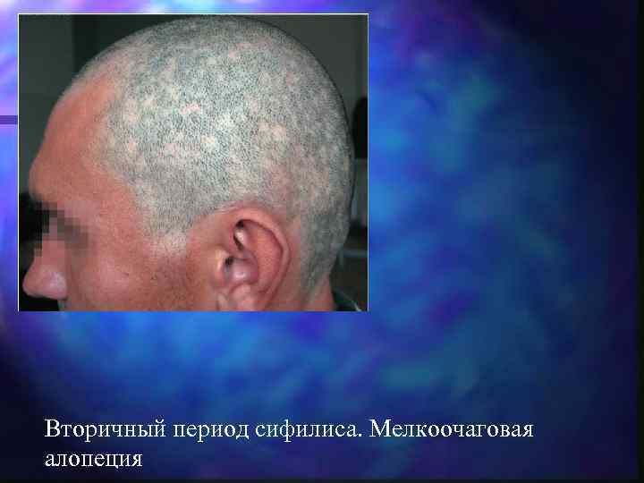 Вторичный период сифилиса. Мелкоочаговая алопеция 