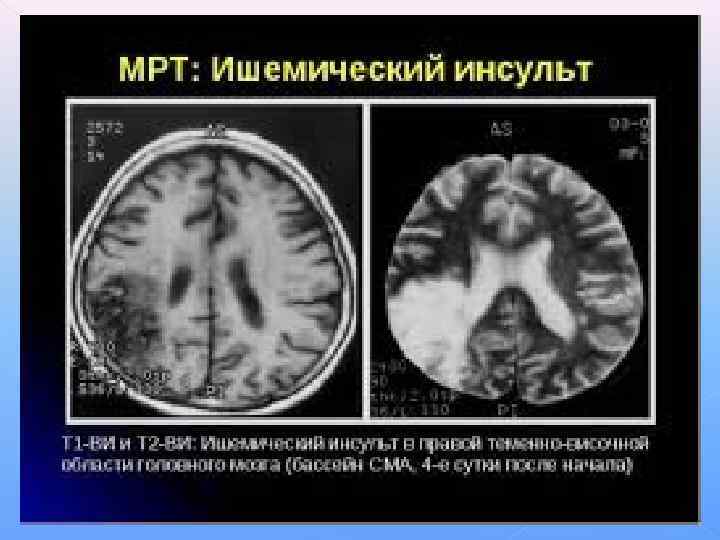 МРТ-дағы ми инфарктісінің көрінісі. 