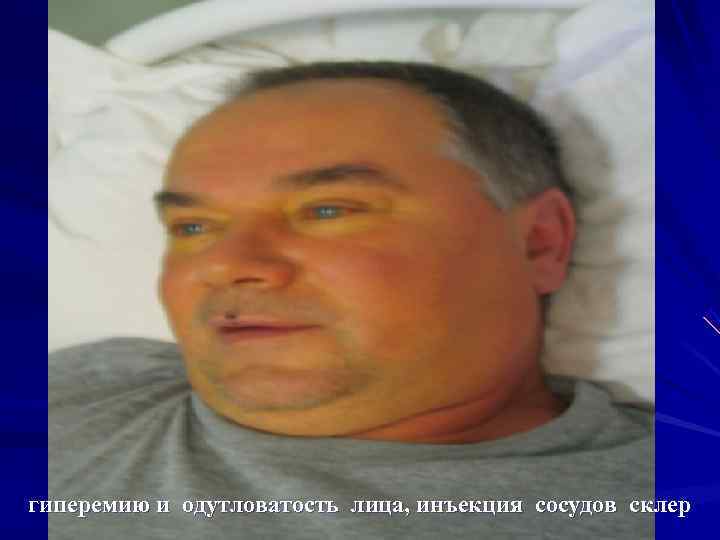 гиперемию и одутловатость лица, инъекция сосудов склер гиперемию и одутловатость лица, инъекция сосудов склер