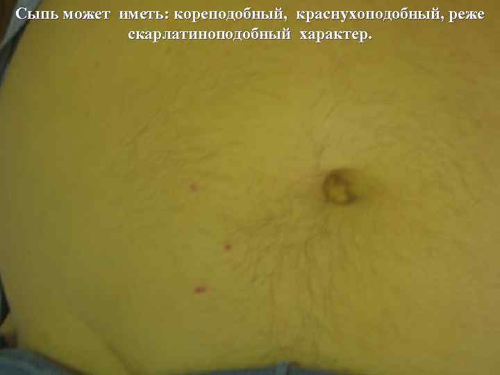 Сыпь может иметь: кореподобный, краснухоподобный, реже скарлатиноподобный характер. Сыпь может иметь: кореподобный, краснухоподобный, реже скарлатиноподобный характер.