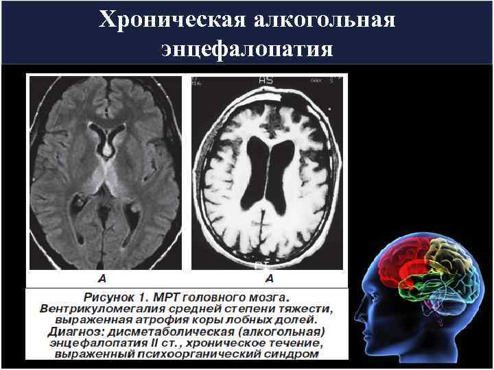 Хроническая алкогольная энцефалопатия 
