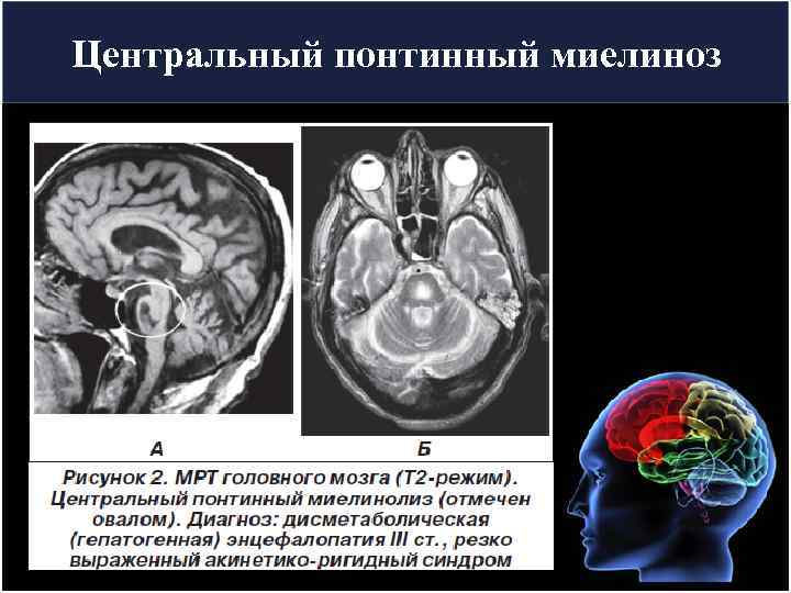 Центральный понтинный миелиноз 