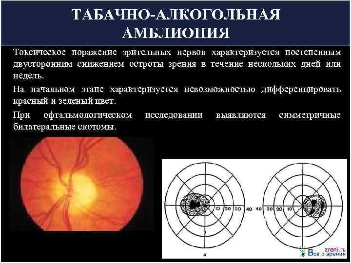    ТАБАЧНО-АЛКОГОЛЬНАЯ    АМБЛИОПИЯ Токсическое поражение зрительных нервов характеризуется постепенным