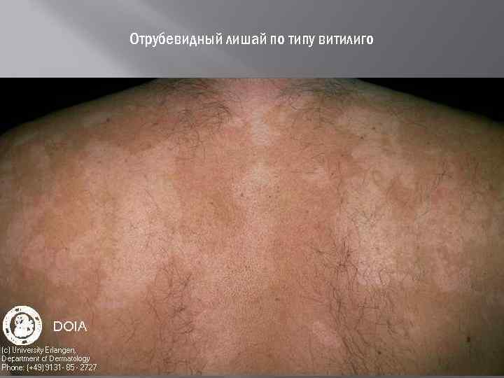 Отрубевидный лишай по типу витилиго 