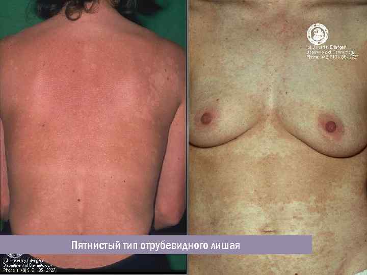 Пятнистый тип отрубевидного лишая 