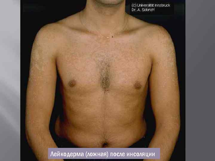 Лейкодерма (ложная) после инсоляции 