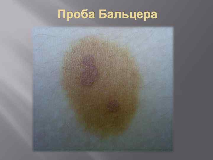 Проба Бальцера 