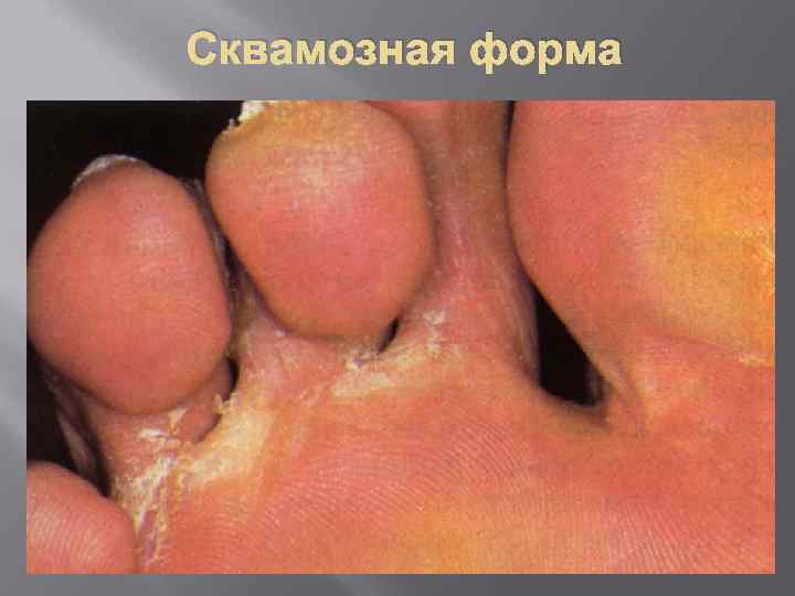 Сквамозная форма 