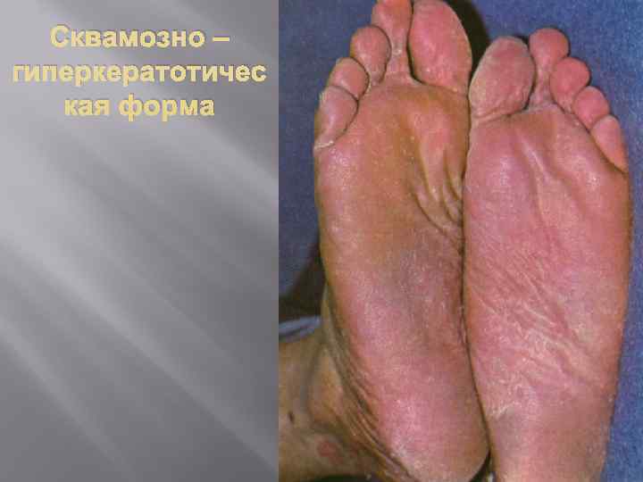  Сквамозно – гиперкератотичес  кая форма 