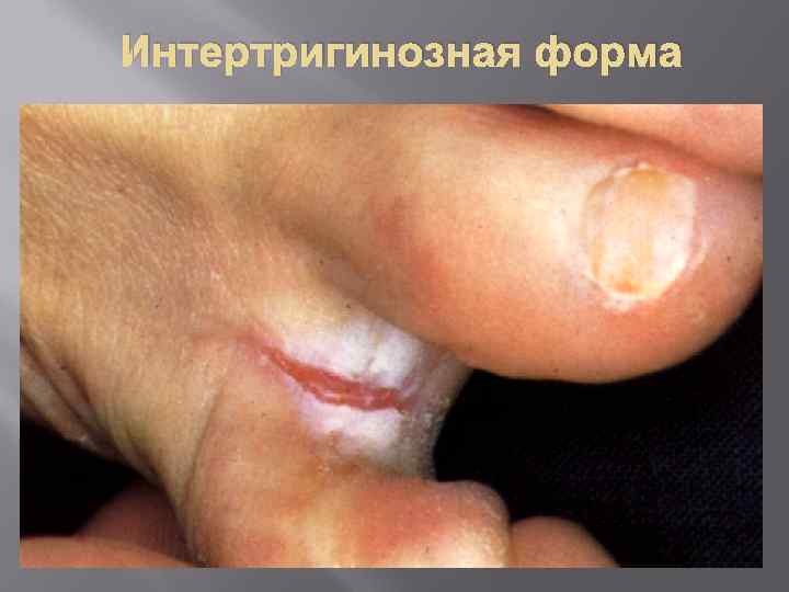 Интертригинозная форма 
