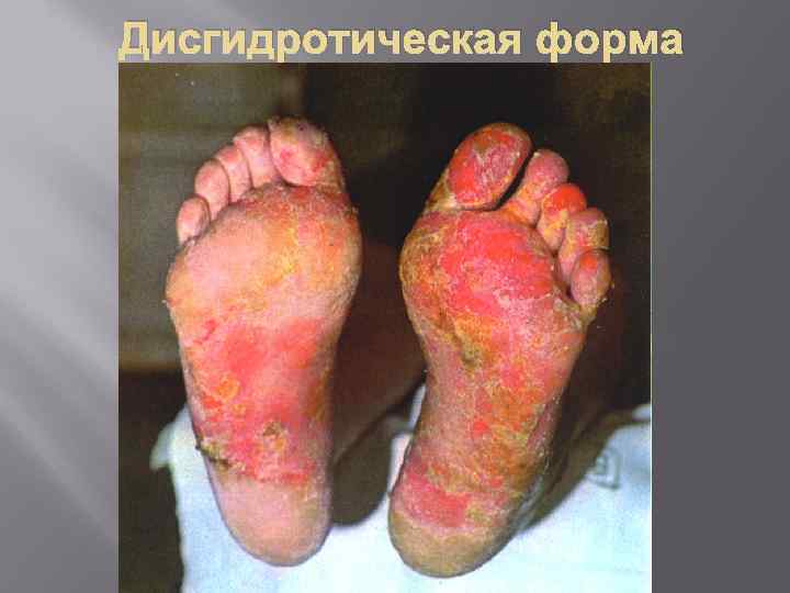 Дисгидротическая форма 