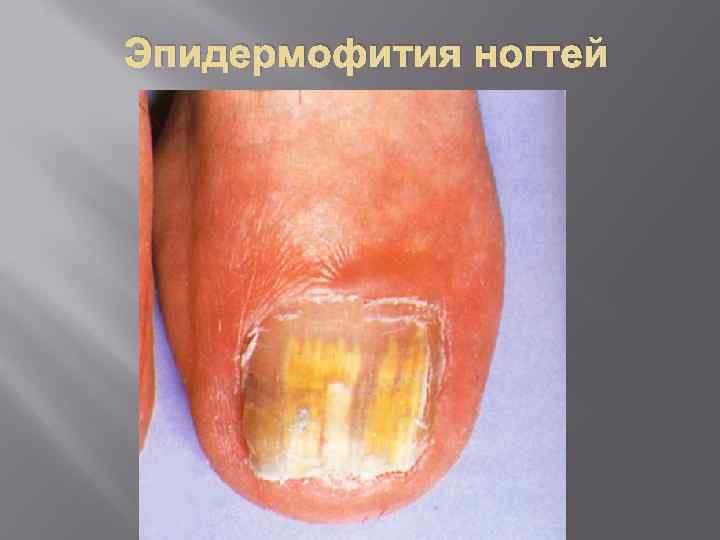 Эпидермофития ногтей 