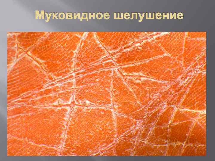 Муковидное шелушение 