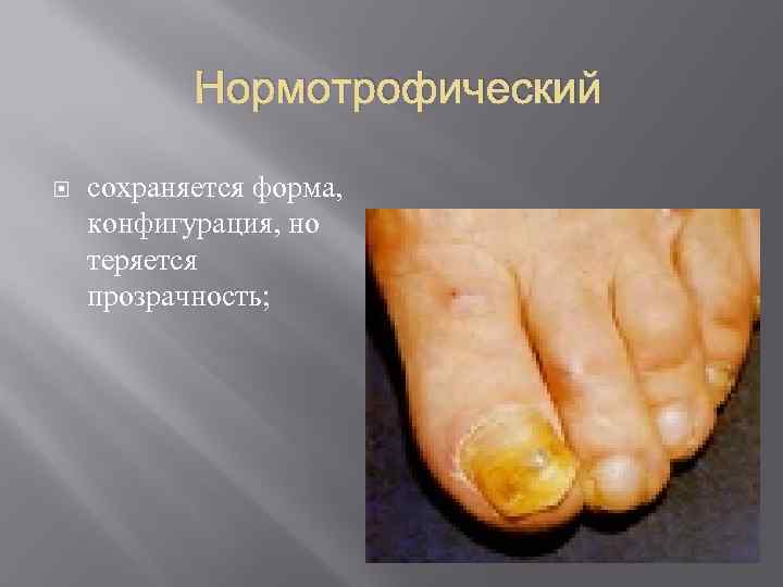   Нормотрофический сохраняется форма, конфигурация, но теряется прозрачность; 