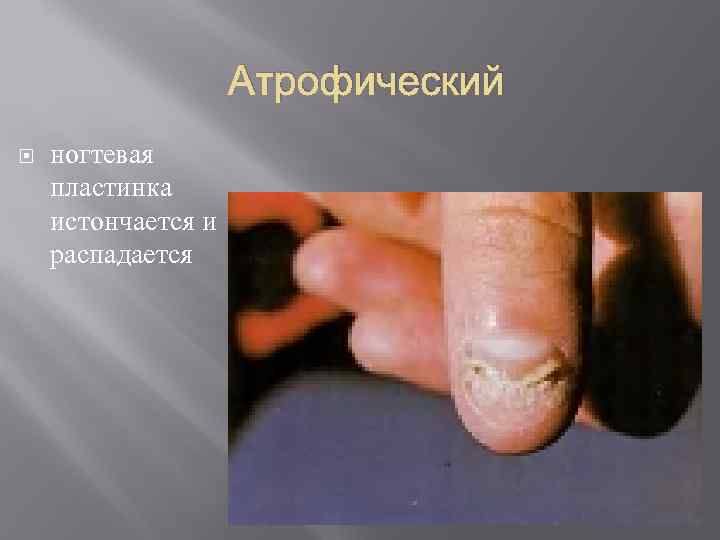     Атрофический ногтевая пластинка истончается и распадается 