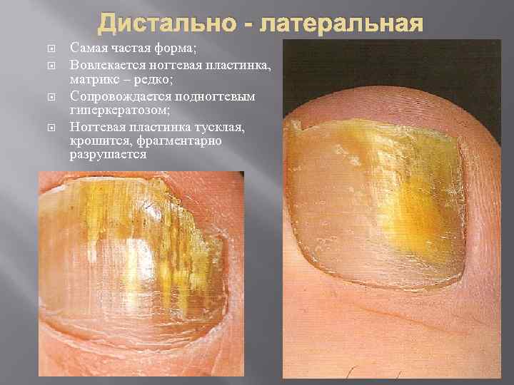   Дистально - латеральная Самая частая форма; Вовлекается ногтевая пластинка, матрикс – редко;