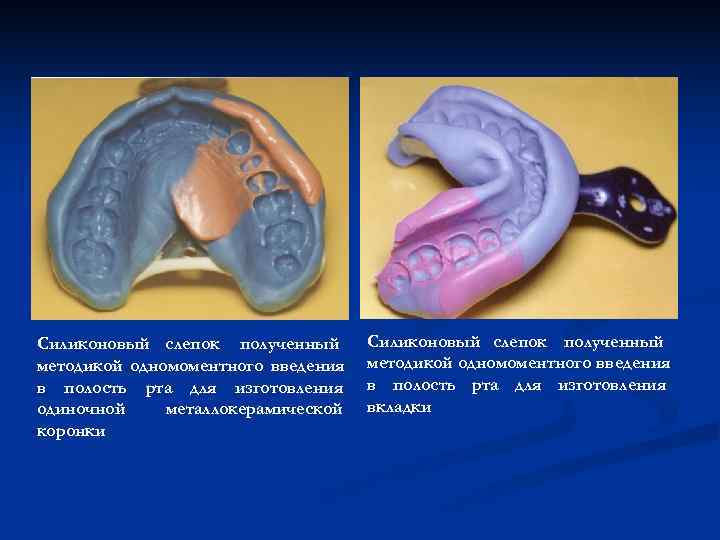 Силиконовый слепок полученный методикой одномоментного введения в полость рта для изготовления одиночной металлокерамической 