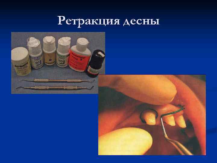 Ретракция десны 