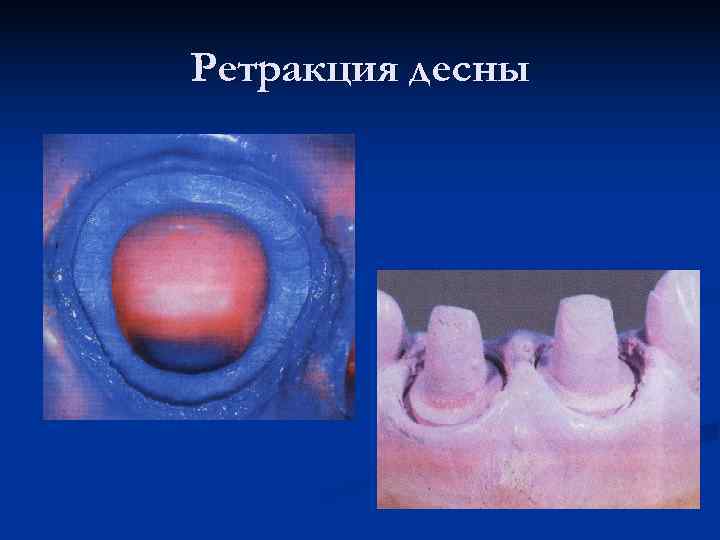 Ретракция десны 