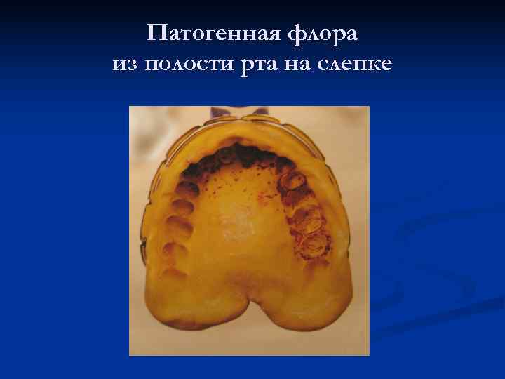   Патогенная флора из полости рта на слепке 