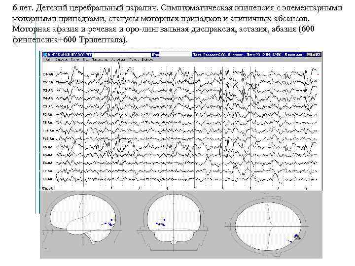 6 лет. Детский церебральный паралич. Симптоматическая эпилепсия с элементарными моторными припадками, статусы моторных припадков