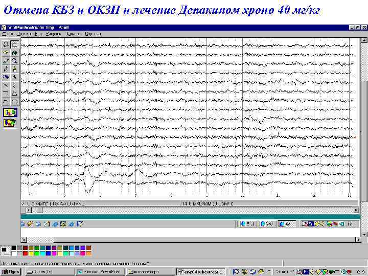 Отмена КБЗ и ОКЗП и лечение Депакином хроно 40 мг/кг 