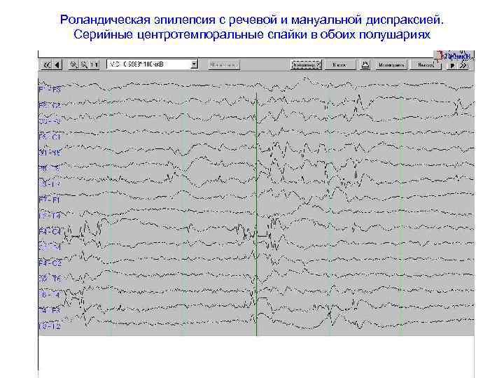 Роландическая эпилепсия с речевой и мануальной диспраксией.  Серийные центротемпоральные спайки в обоих полушариях