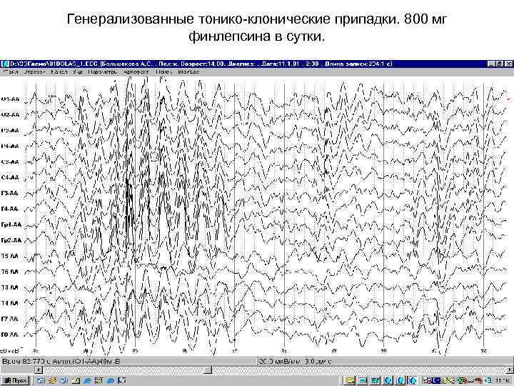 Генерализованные тонико-клонические припадки. 800 мг    финлепсина в сутки. 