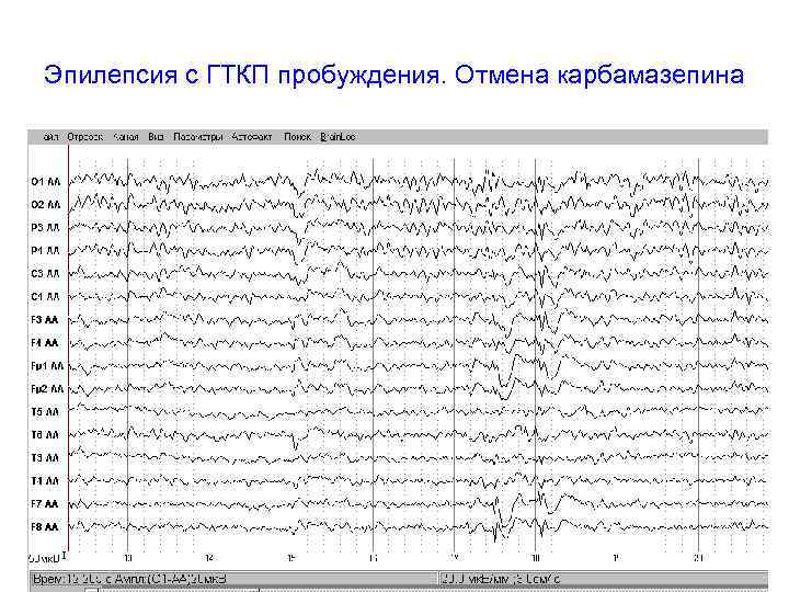 Эпилепсия с ГТКП пробуждения. Отмена карбамазепина 