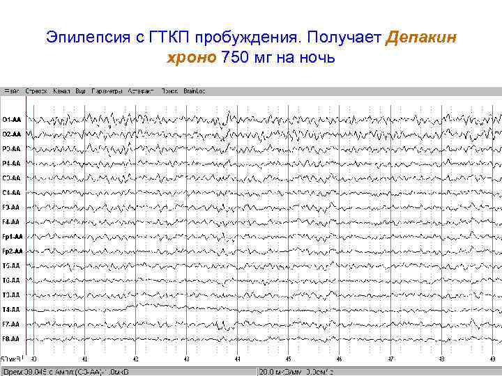 Эпилепсия с ГТКП пробуждения. Получает Депакин    хроно 750 мг на ночь