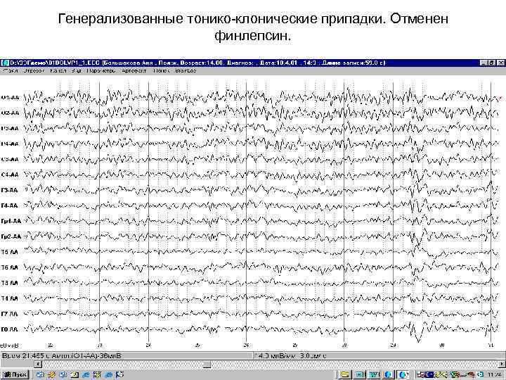 Генерализованные тонико-клонические припадки. Отменен     финлепсин. 