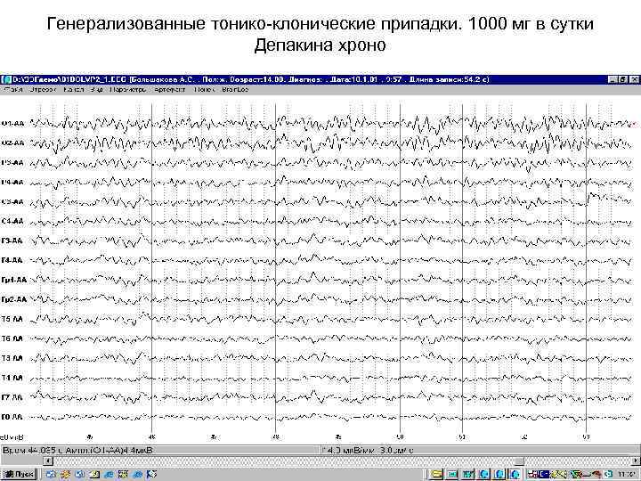 Генерализованные тонико-клонические припадки. 1000 мг в сутки    Депакина хроно 