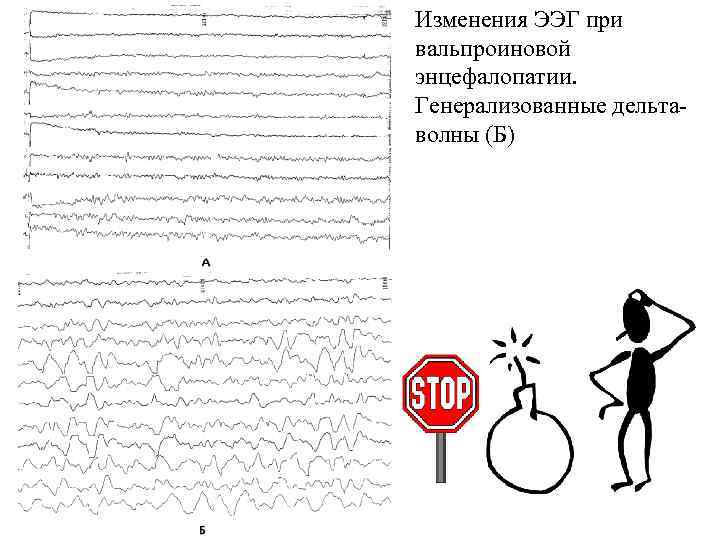 Изменения ЭЭГ при вальпроиновой энцефалопатии. Генерализованные дельта- волны (Б) 