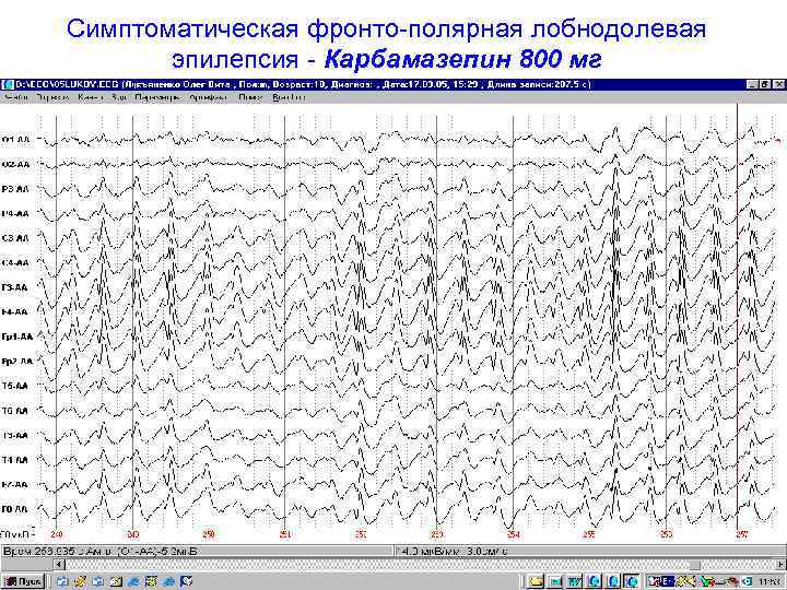 Симптоматическая фронто-полярная лобнодолевая  эпилепсия - Карбамазепин 800 мг 